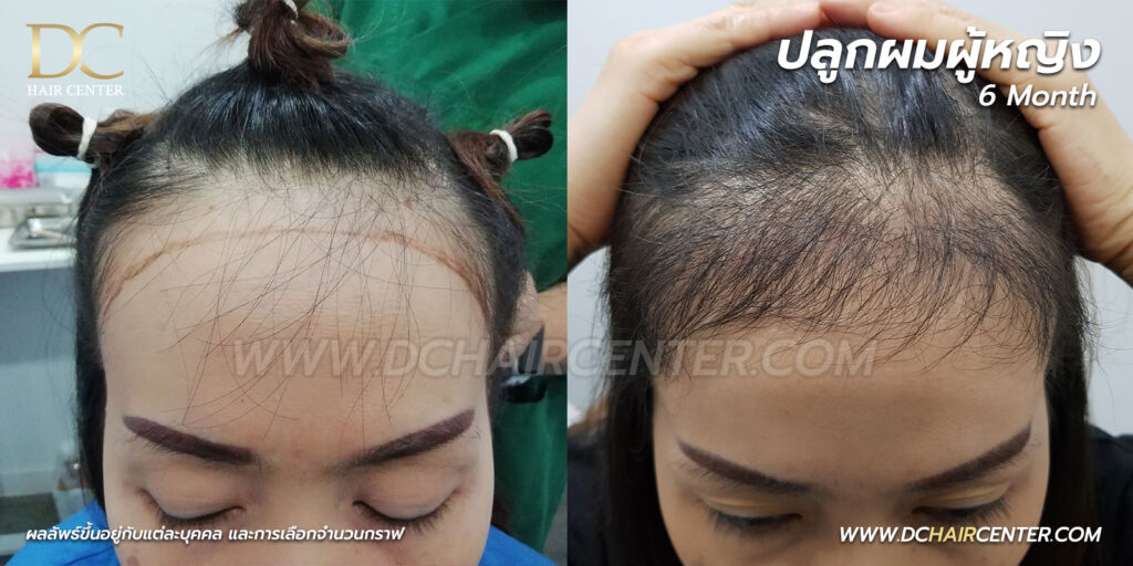 ปลูกผมถาวรผู้หญิง เชียงใหม่ รีวิว