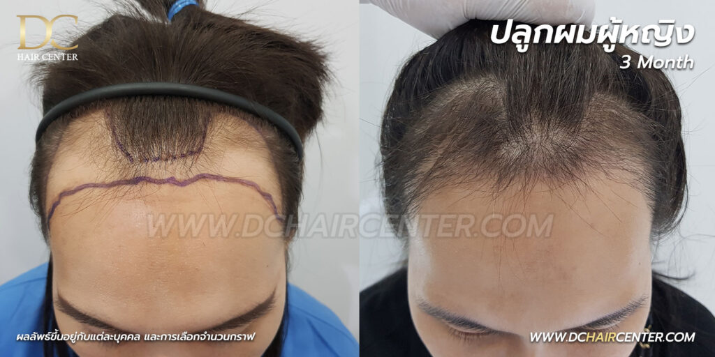 ปลูกผมถาวรผู้หญิง เชียงใหม่ รีวิว