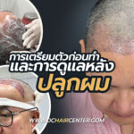 การเตรียมตัวก่อนทำ การดูแลและอาการหลังศัลยกรรมปลูกผมถาวร