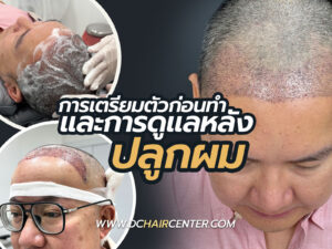 การเตรียมตัวก่อนทำ การดูแลและอาการหลังศัลยกรรมปลูกผมถาวร